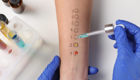 Allergy Skin Tests: What to Expect During a Basic Allergy Workup