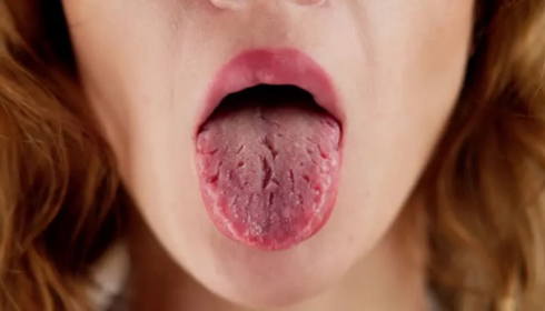 Dry Mouth Problems Causes, Daily Discomfort and Simple Ways to Get Relief
