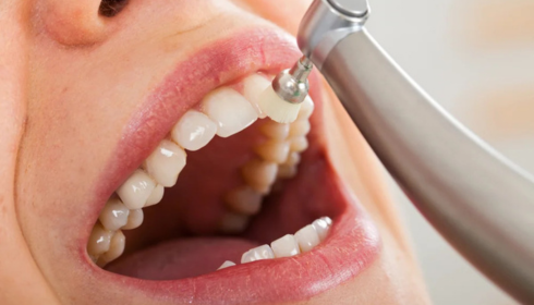 Fluoride Treatments at the Dentist When Extra Protection Makes Sense for Adults