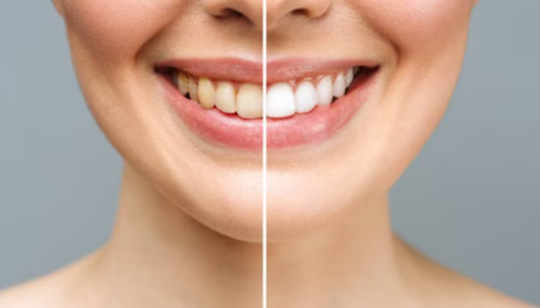Hidden Sugar in Everyday Drinks How Soft Beverages Quietly Feed Cavities