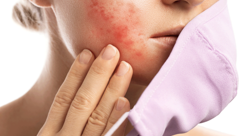 Maskne and Breakouts from Face Masks Prevention Tips for Sensitive Skin
