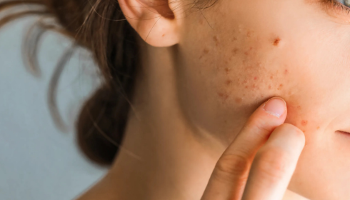 Understanding Skin Purging vs Real Breakouts When Starting New Products